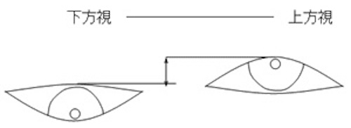 眼瞼下垂の診断　MRD1