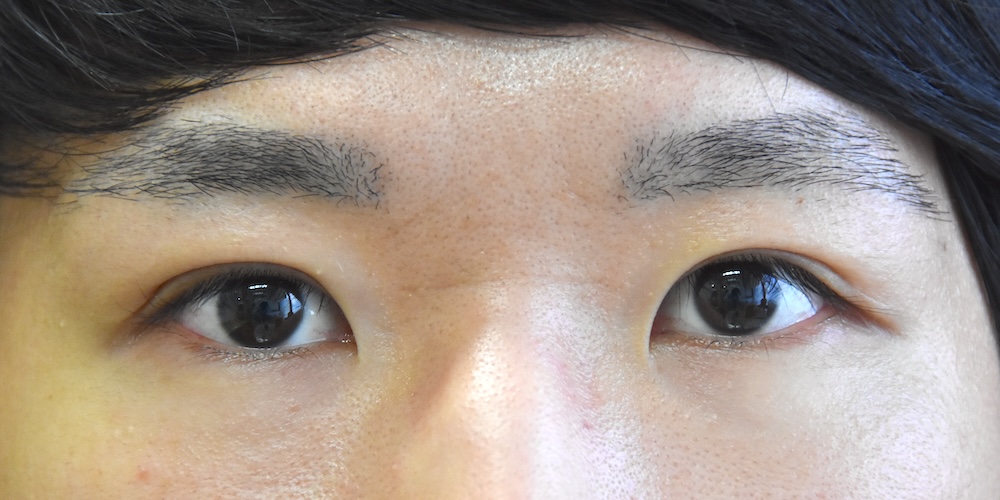 重瞼切開法術後　大江橋クリニック
