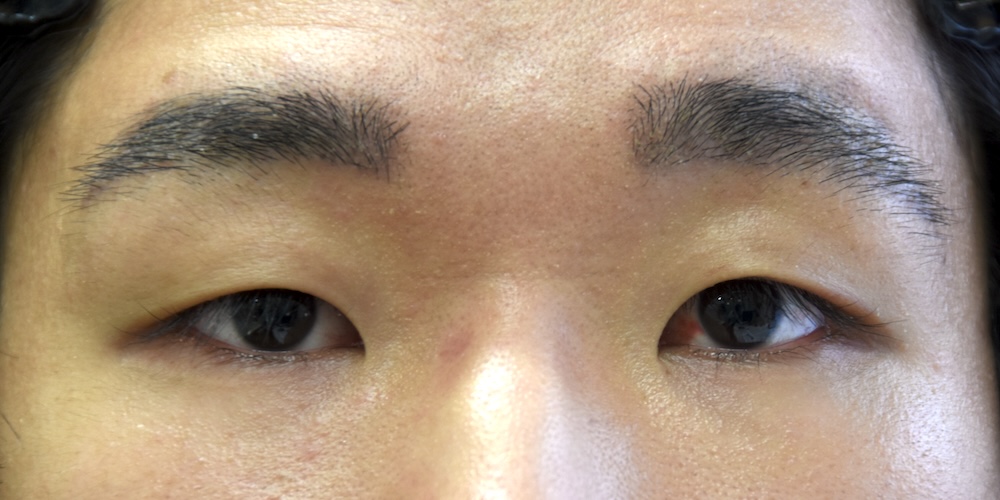 重瞼切開法術前　大江橋クリニック
