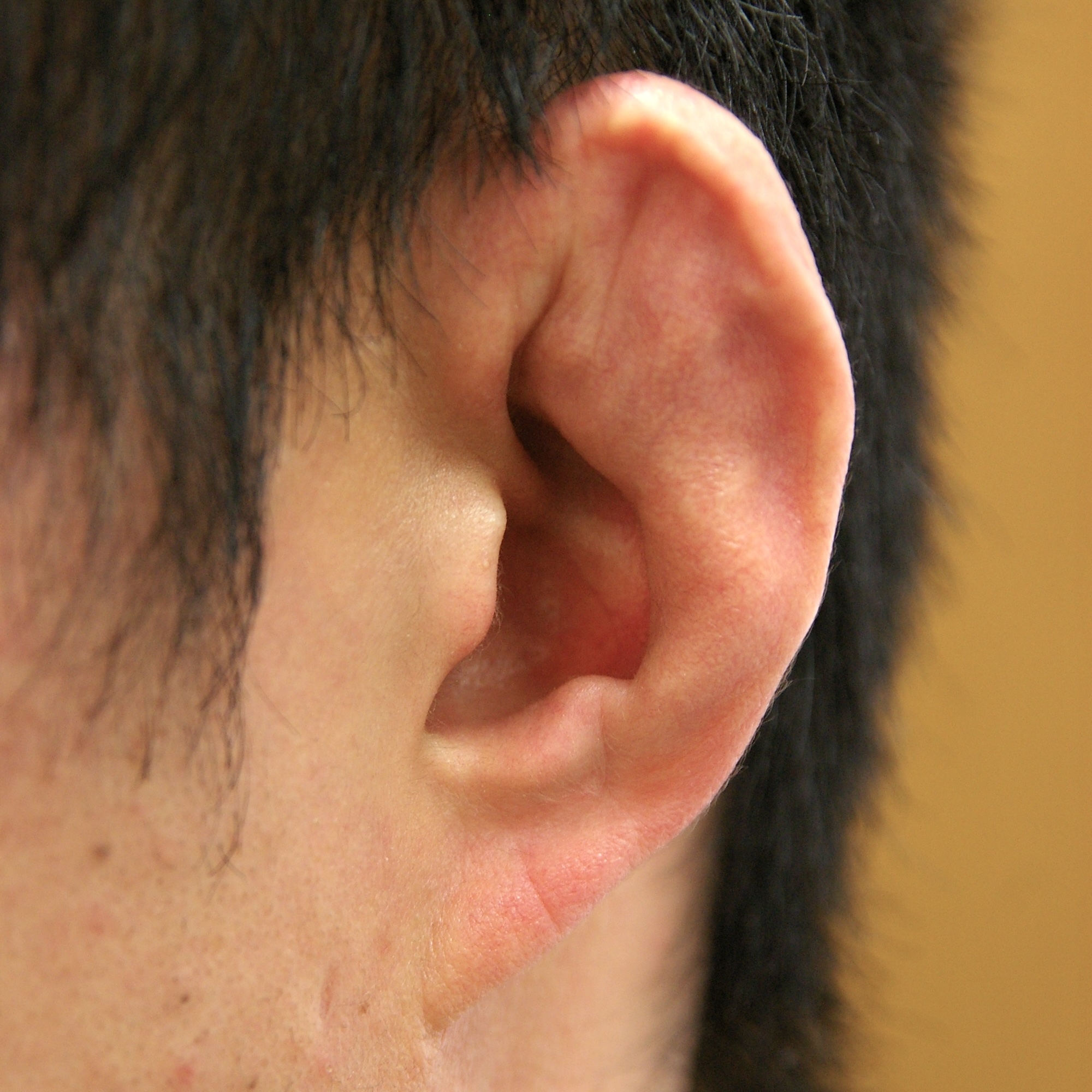 耳介偽嚢腫後の変形術前　大江橋クリニック