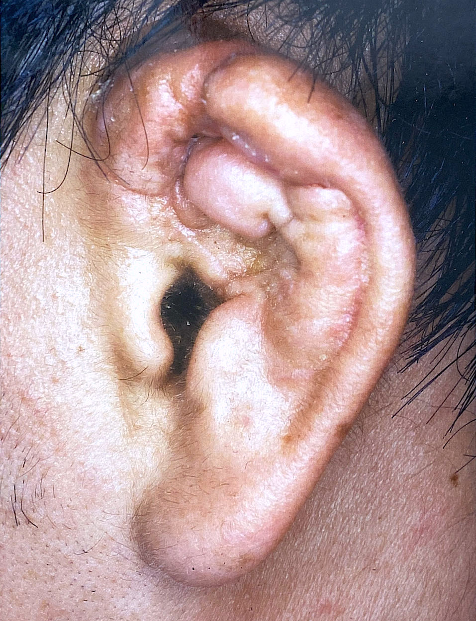柔道耳