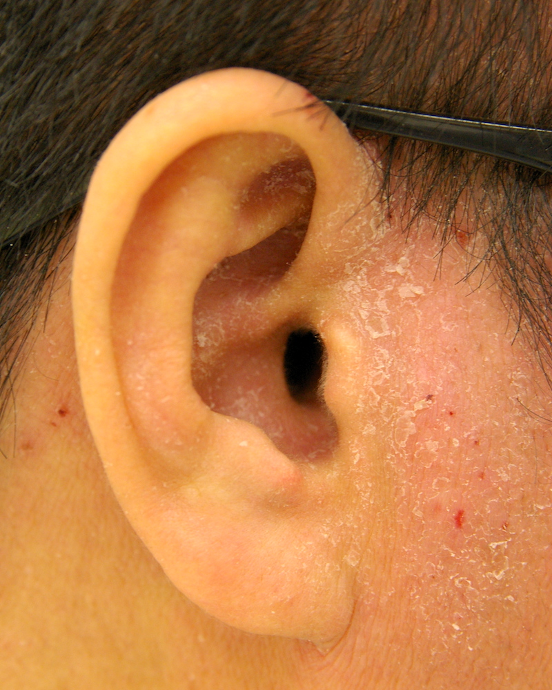 耳のアトピー性皮膚炎