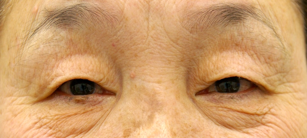 ptosis