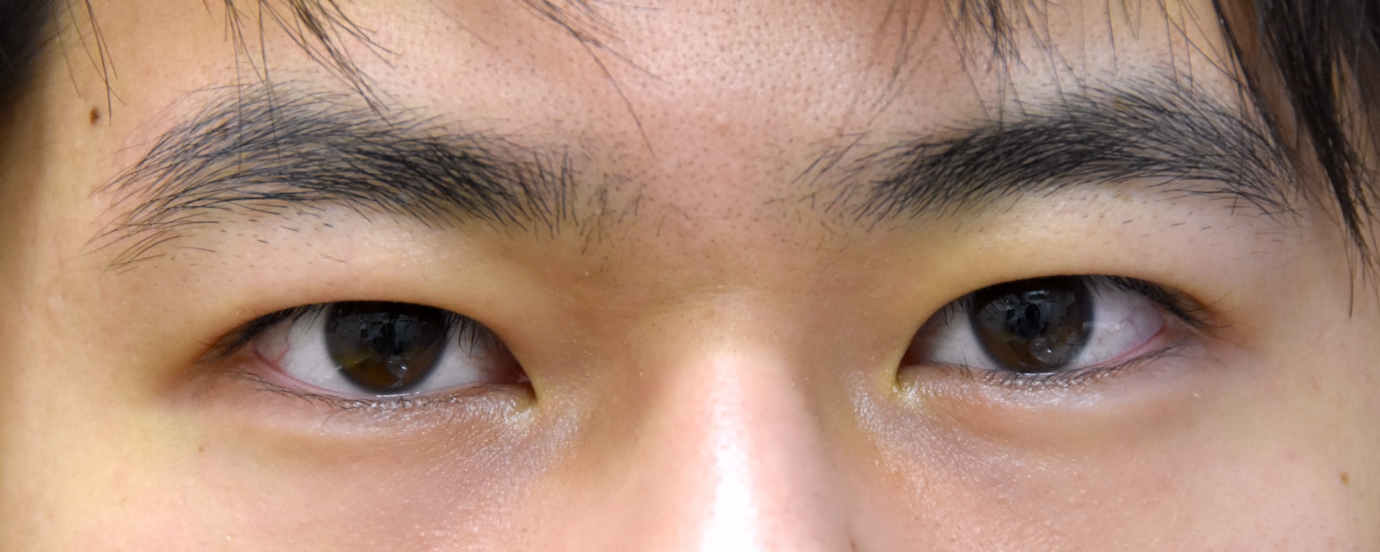 男性眼瞼下垂症術後　大江橋クリニック