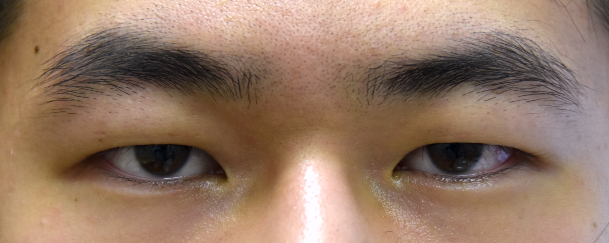男性眼瞼下垂症術前　大江橋クリニック