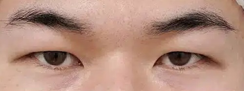一重瞼