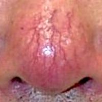 酒さによる鼻の血管拡張