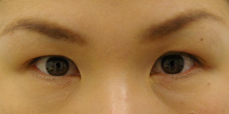 瞼の手術 形成外科 大江橋クリニック 大阪市北区 淀屋橋 北浜