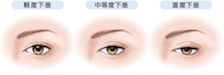 眼瞼下垂の症状