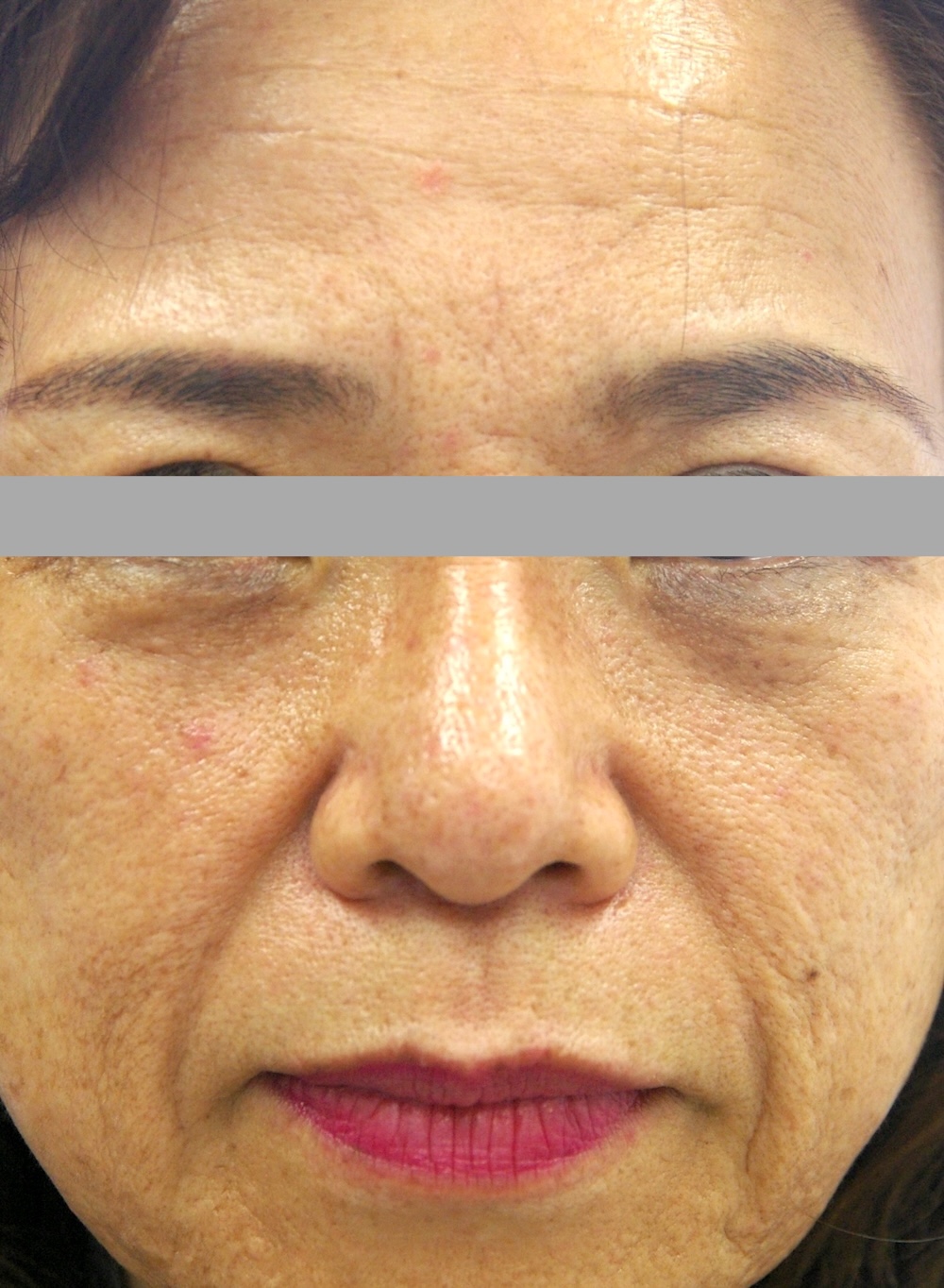 デトックス治療中　大江橋クリニック