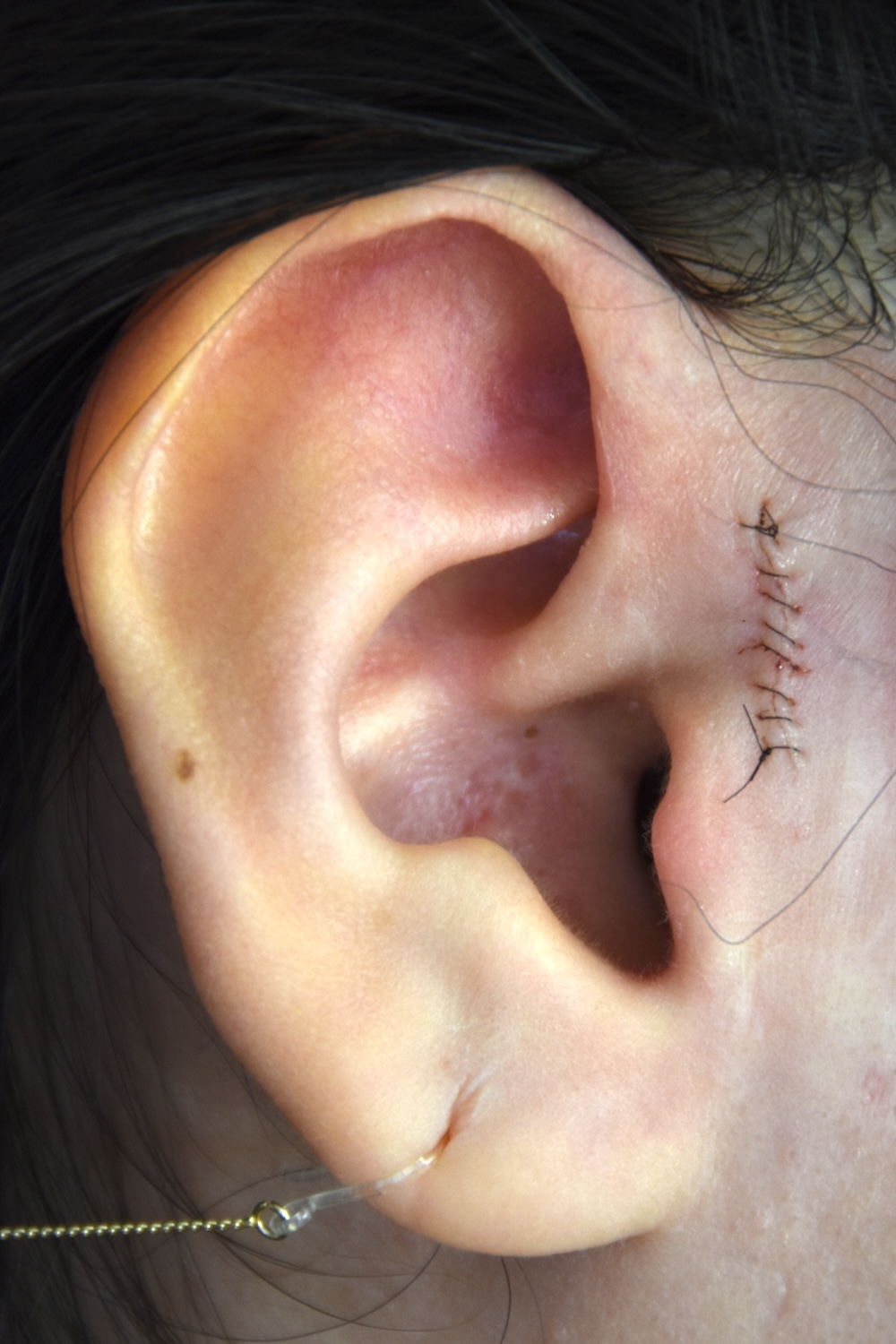 副耳術前　大江橋クリニック