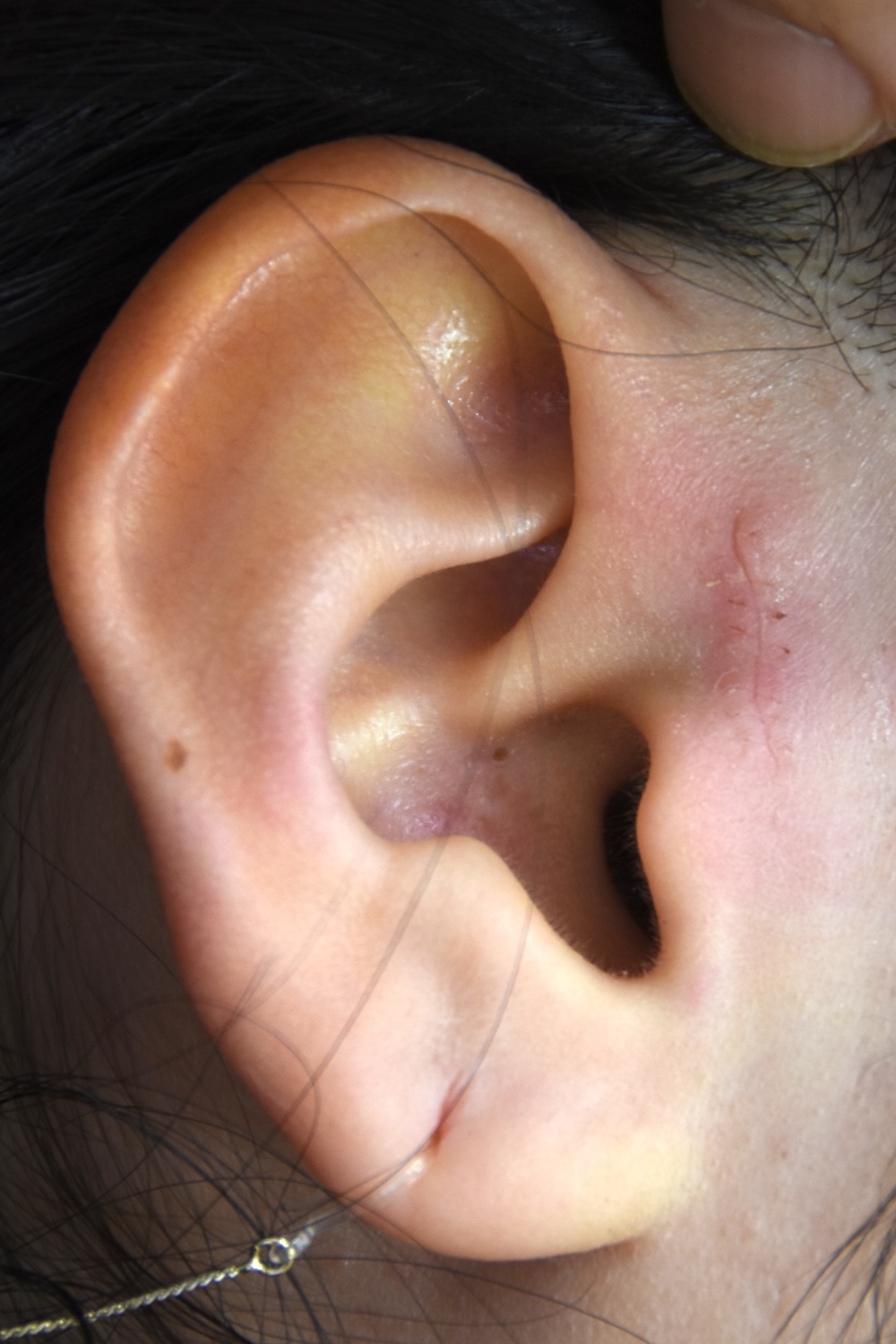 副耳術後　大江橋クリニック