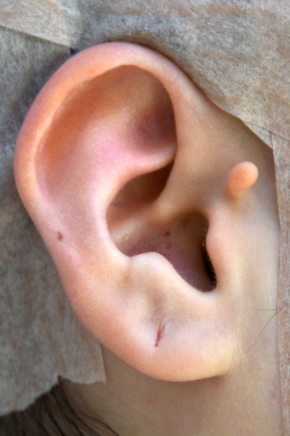 副耳術前　大江橋クリニック