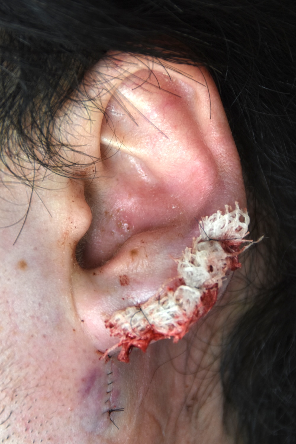 小さな耳たぶを大きく術後　大江橋クリニック