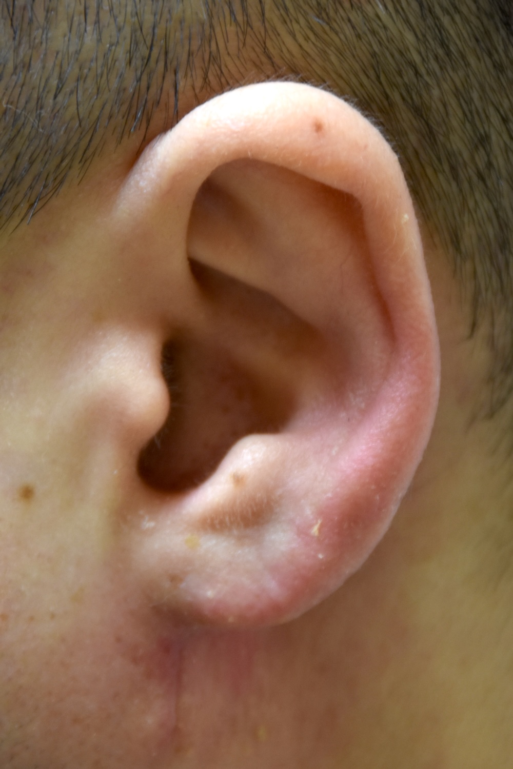 耳たぶの整形術後　大江橋クリニック