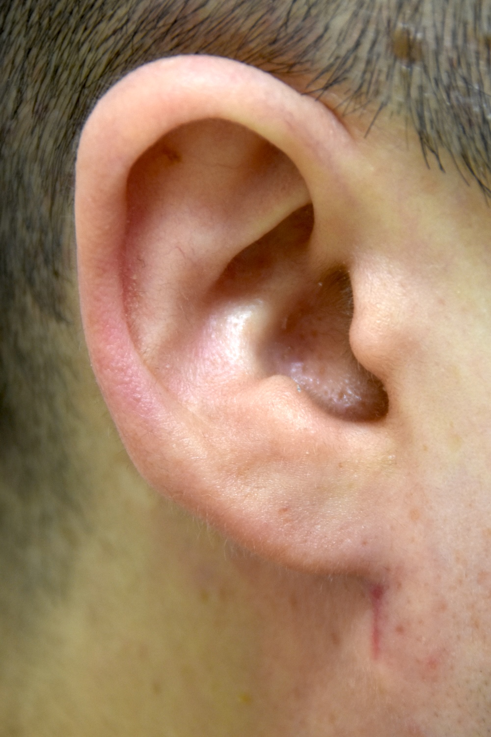 耳たぶの整形術後　大江橋クリニック