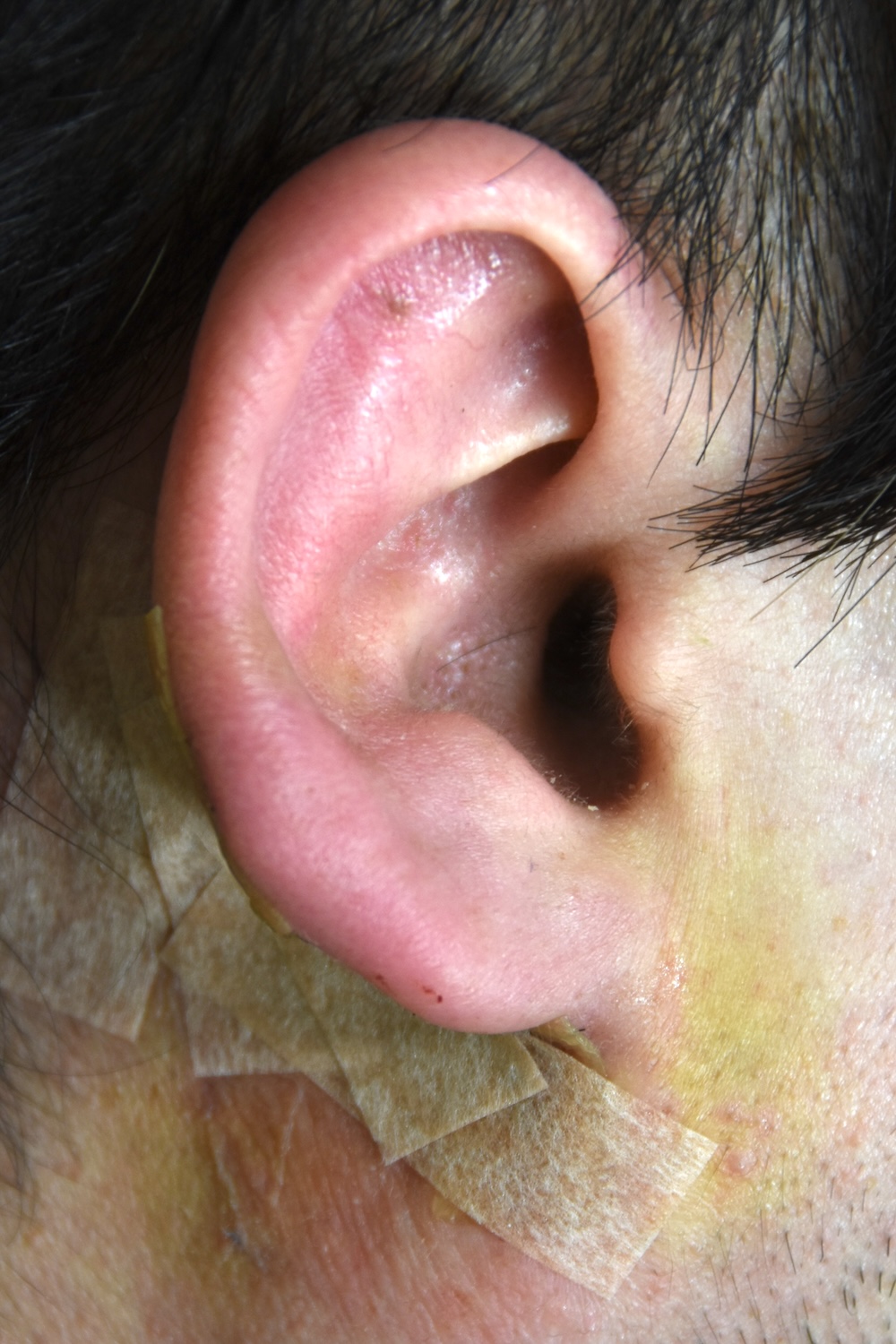 小さな耳たぶを大きく術後　大江橋クリニック