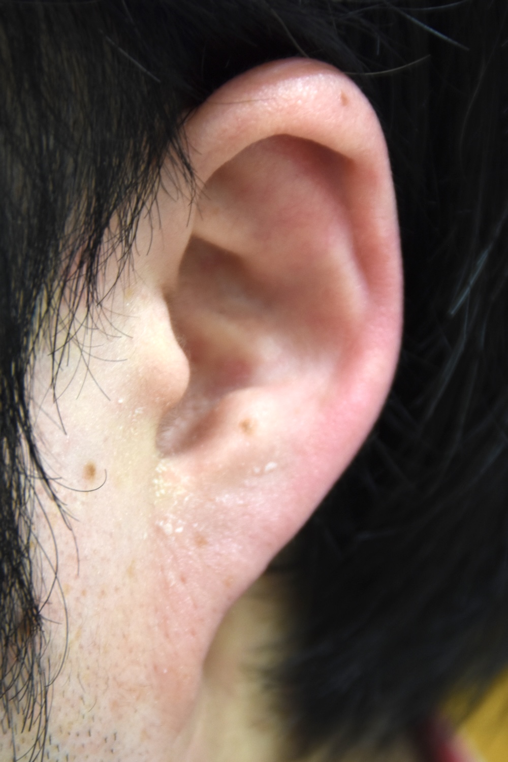 耳たぶの整形術前　大江橋クリニック