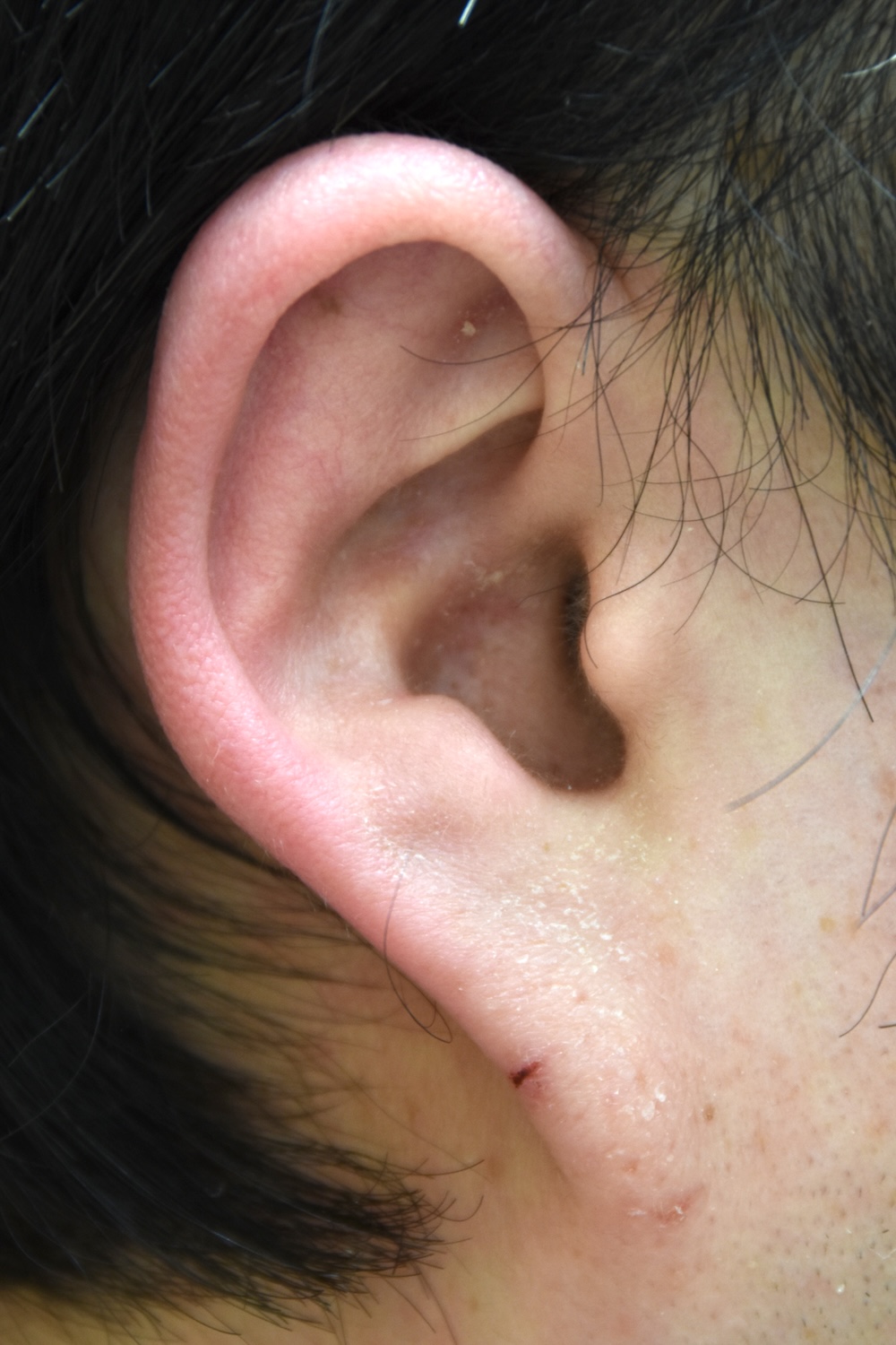 耳たぶの整形術前　大江橋クリニック