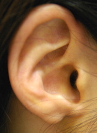 耳たぶの整形術前　大江橋クリニック