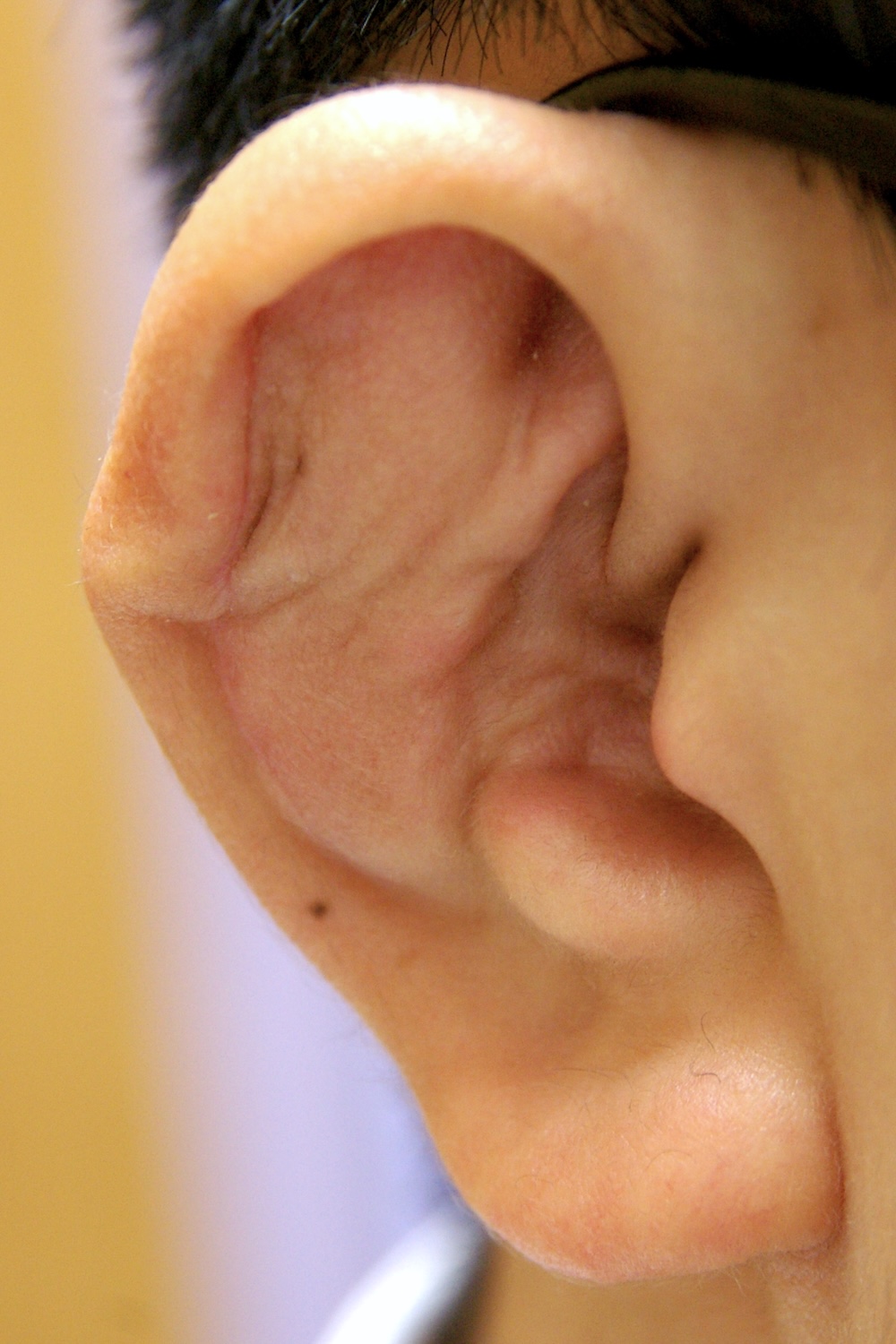 柔道耳術後　大江橋クリニック