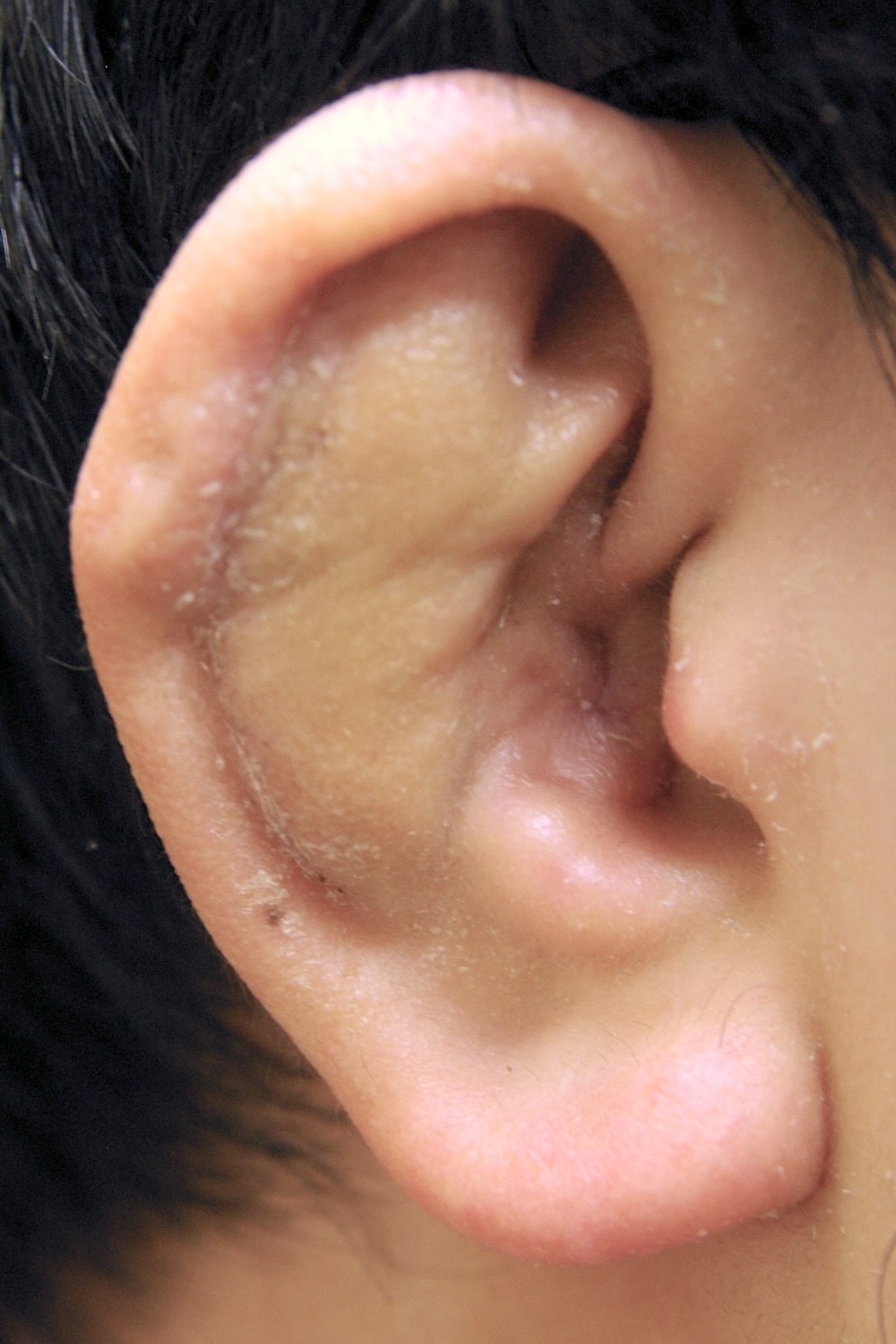 柔道耳術後　大江橋クリニック