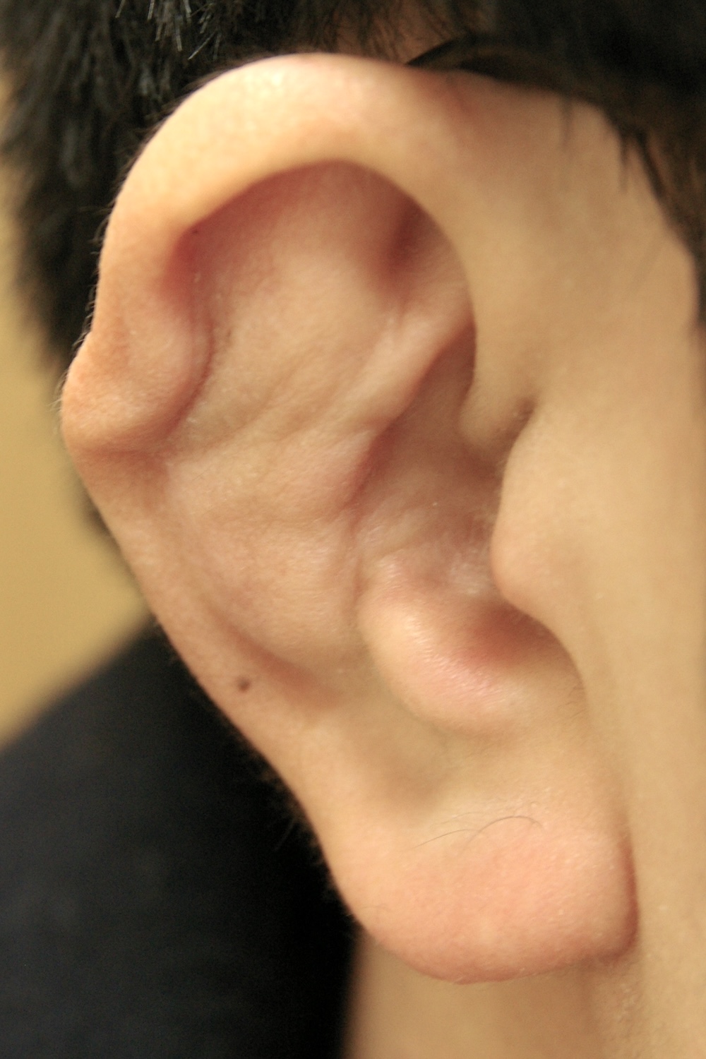 柔道耳術後　大江橋クリニック