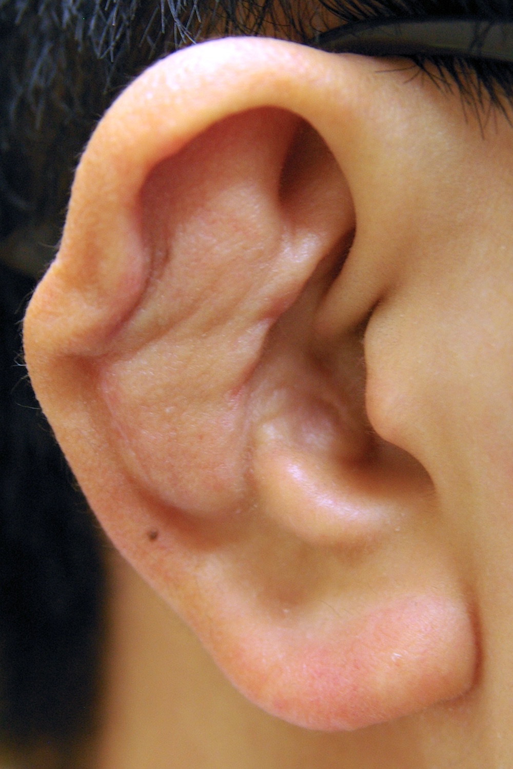 柔道耳術後　大江橋クリニック