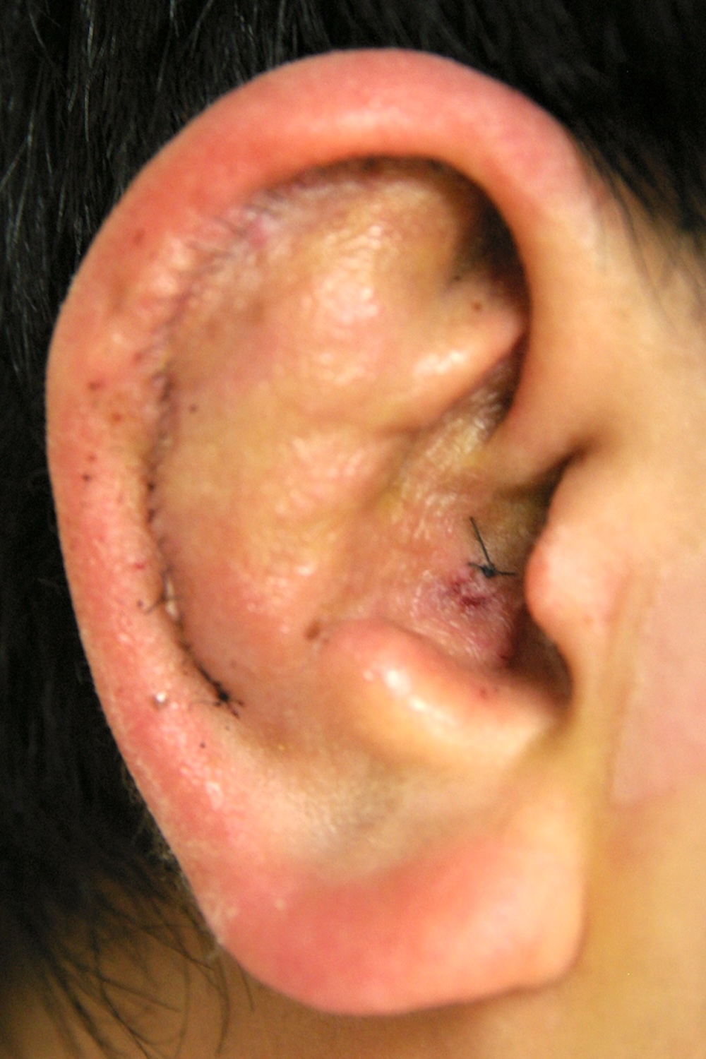 柔道耳術後　大江橋クリニック