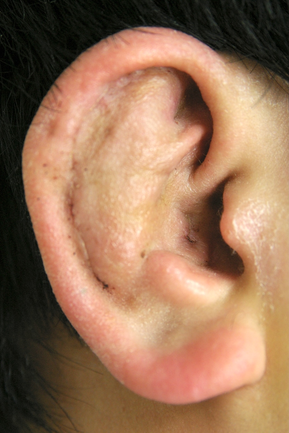 柔道耳術後　大江橋クリニック