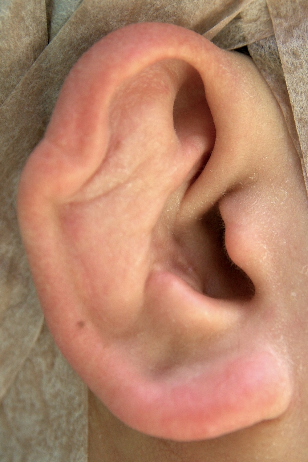 柔道耳修正術前　大江橋クリニック