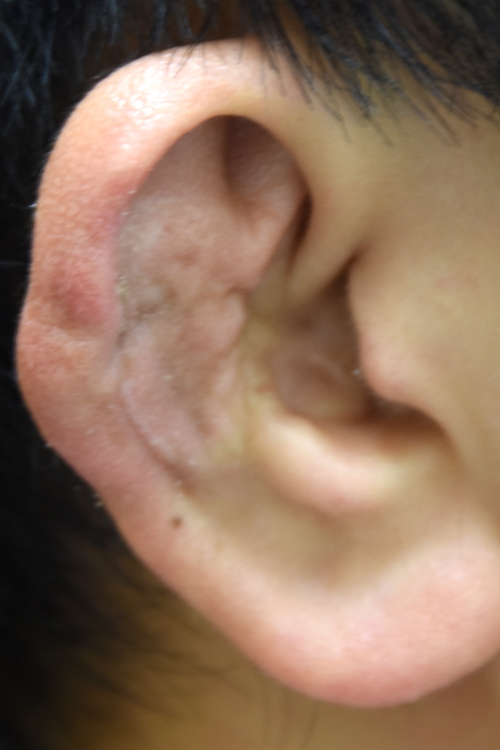 柔道耳術後　大江橋クリニック