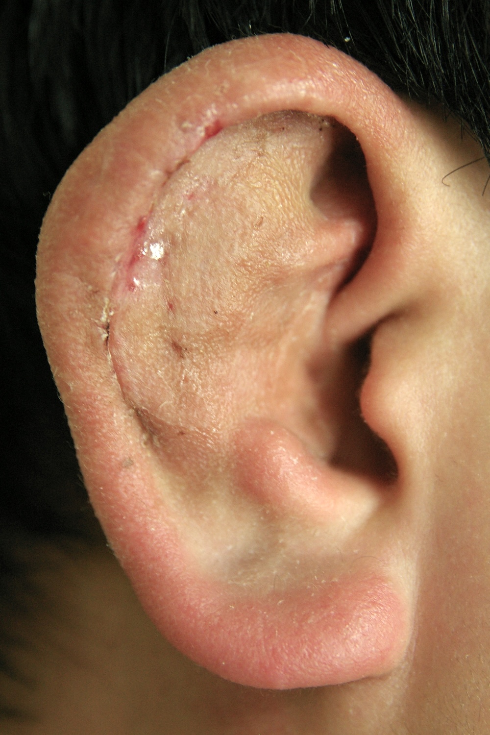 柔道耳術後　大江橋クリニック