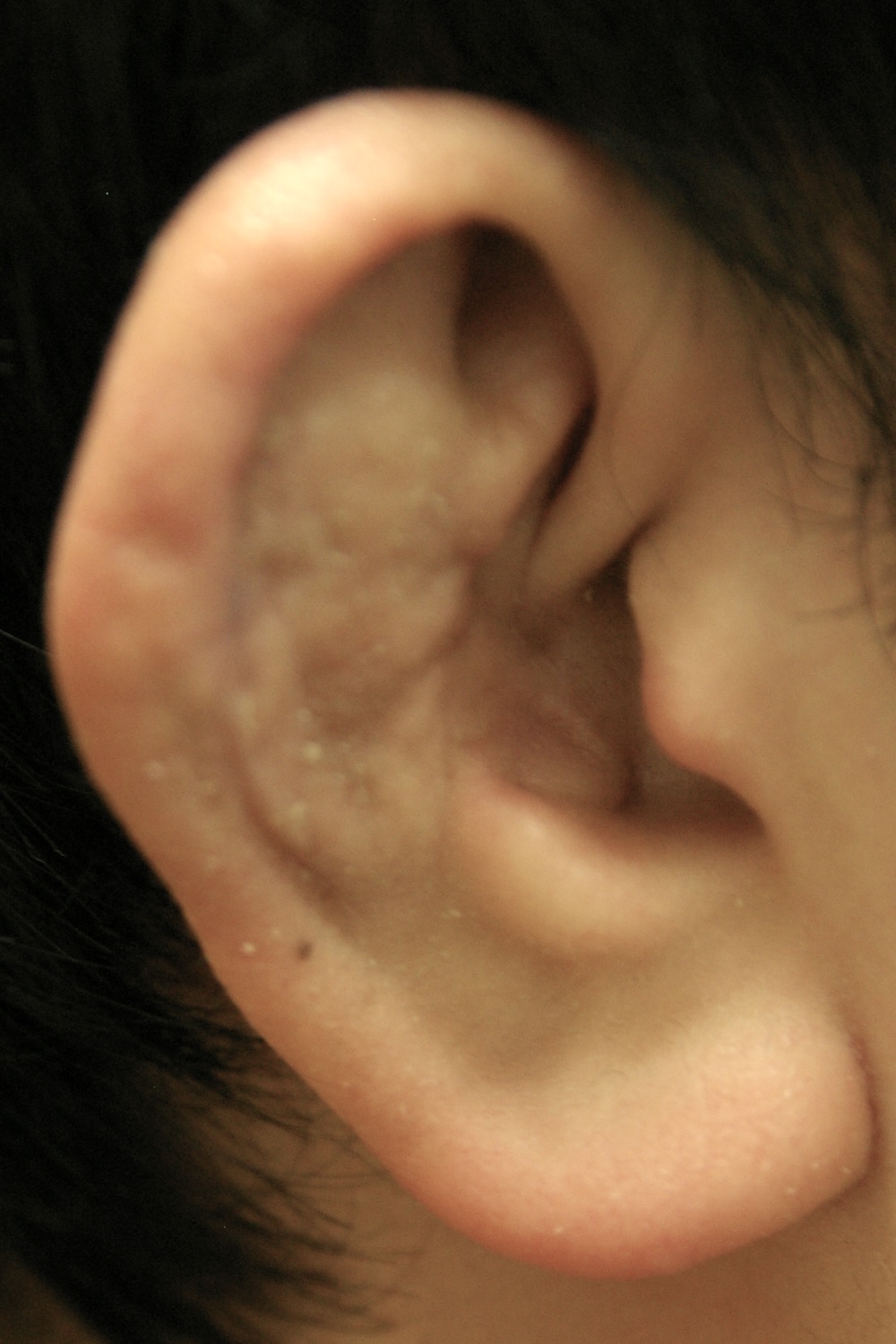 柔道耳術後　大江橋クリニック