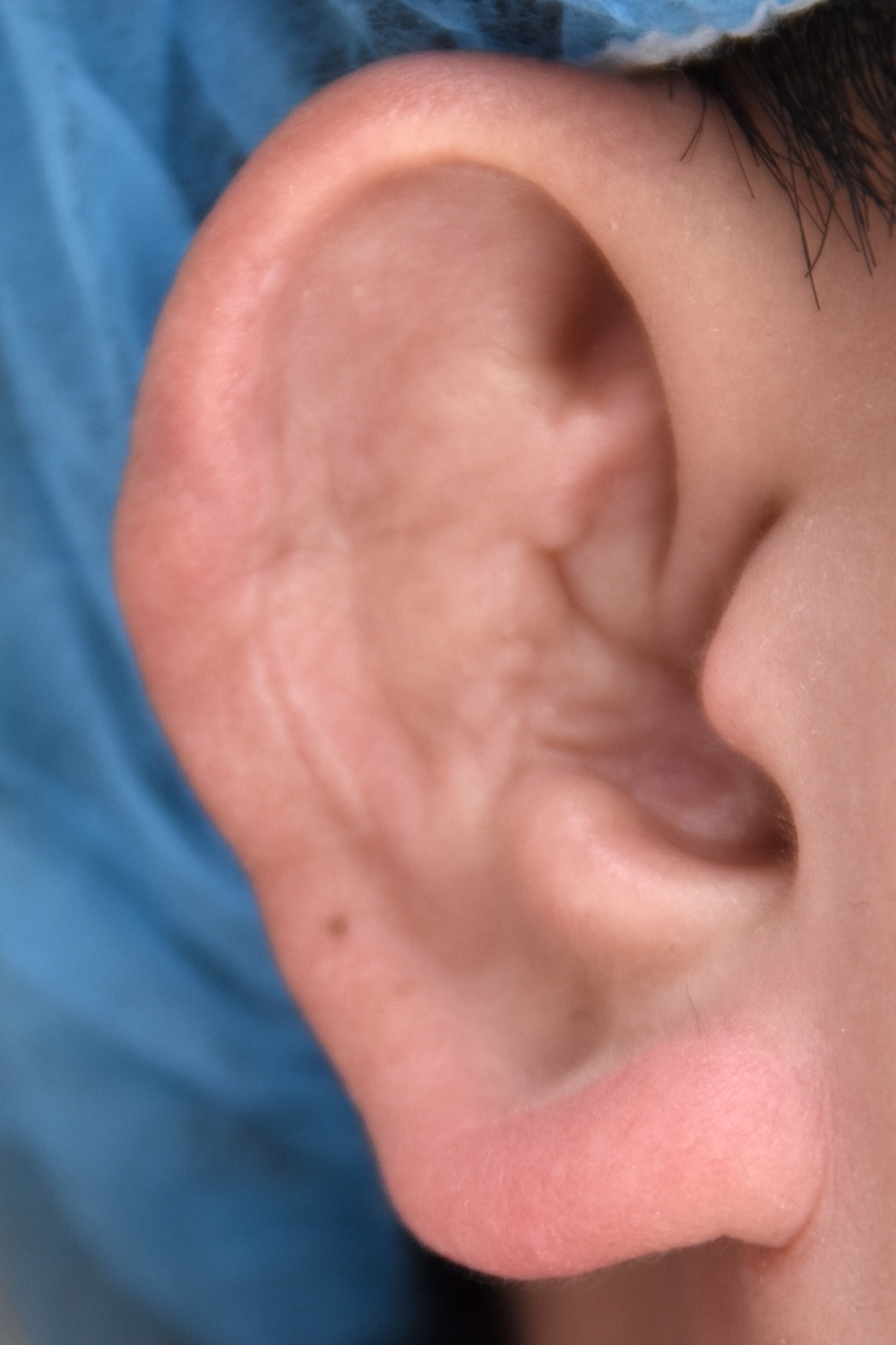 柔道耳修正術前　大江橋クリニック