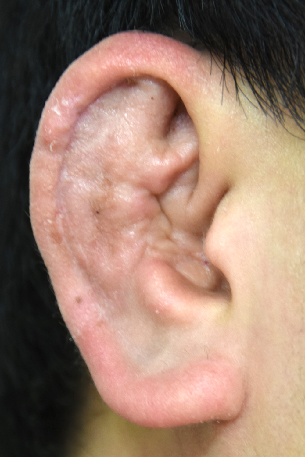 柔道耳術後　大江橋クリニック