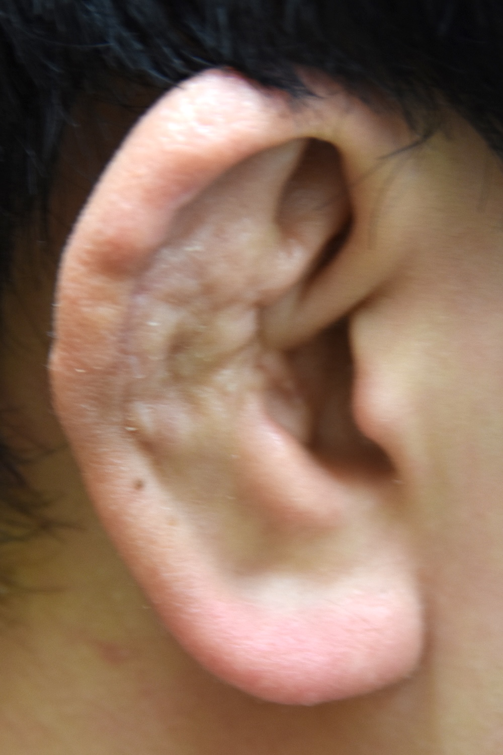 柔道耳術後　大江橋クリニック