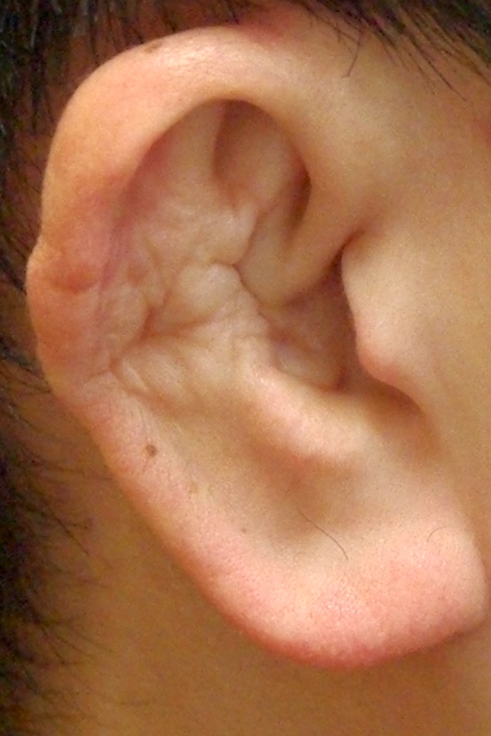 柔道耳術後　大江橋クリニック