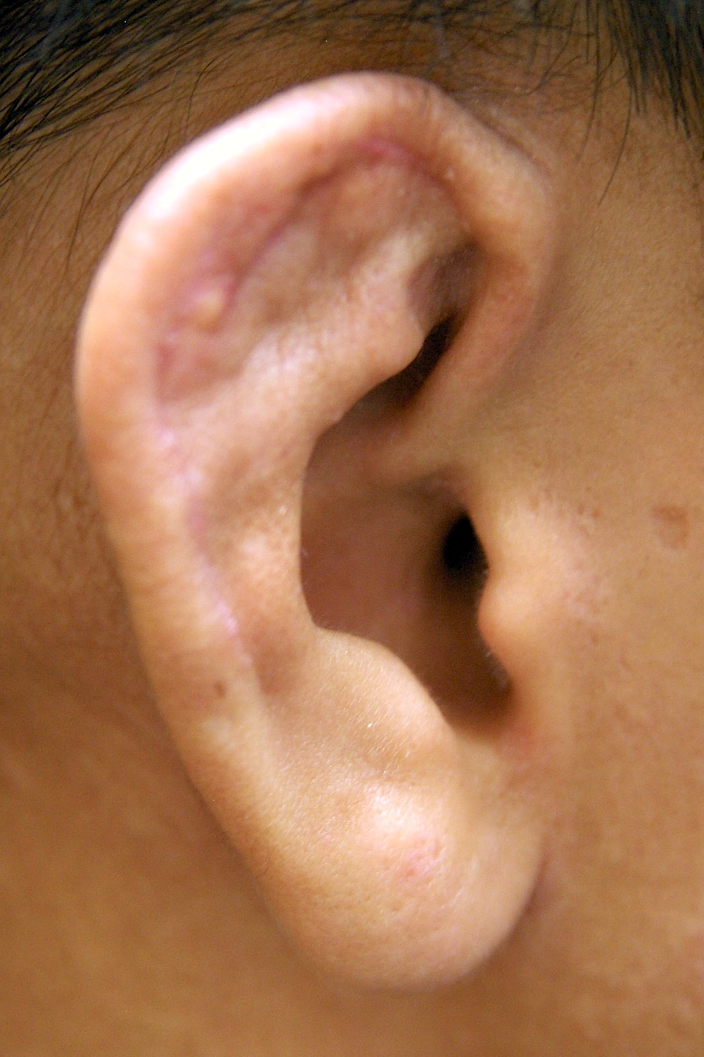 柔道耳術後　大江橋クリニック