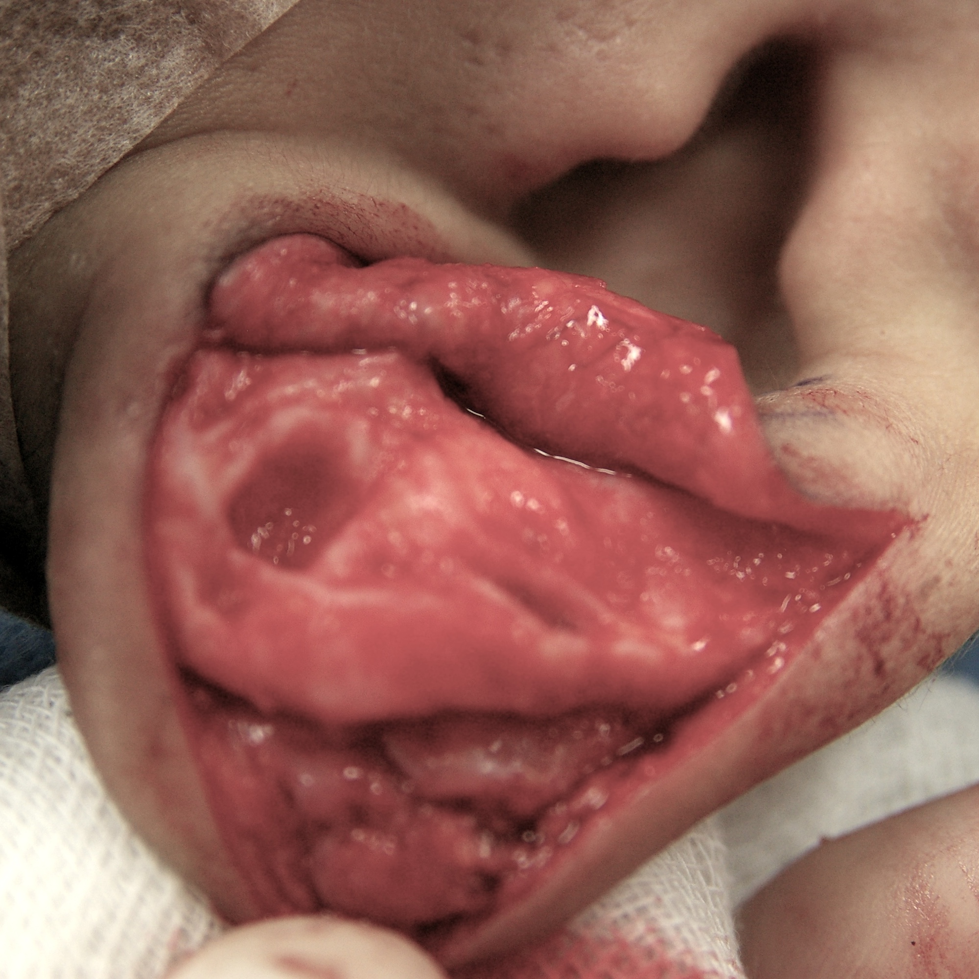 柔道耳手術中　大江橋クリニック