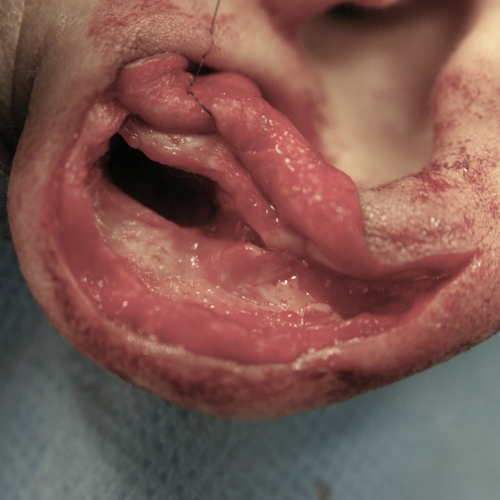 柔道耳手術中　大江橋クリニック