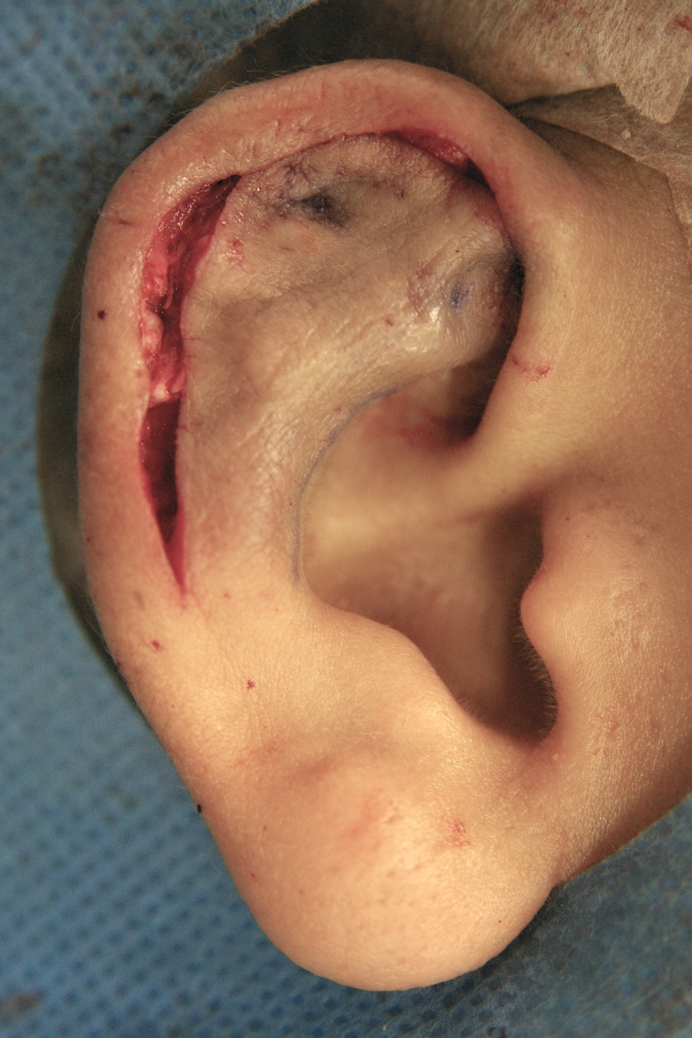 柔道耳手術中　大江橋クリニック