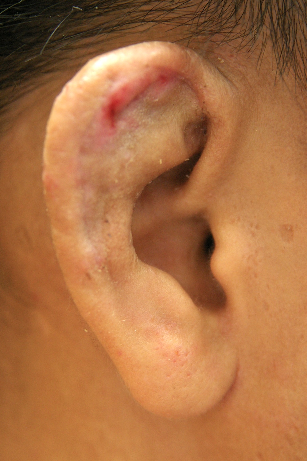 柔道耳術後　大江橋クリニック