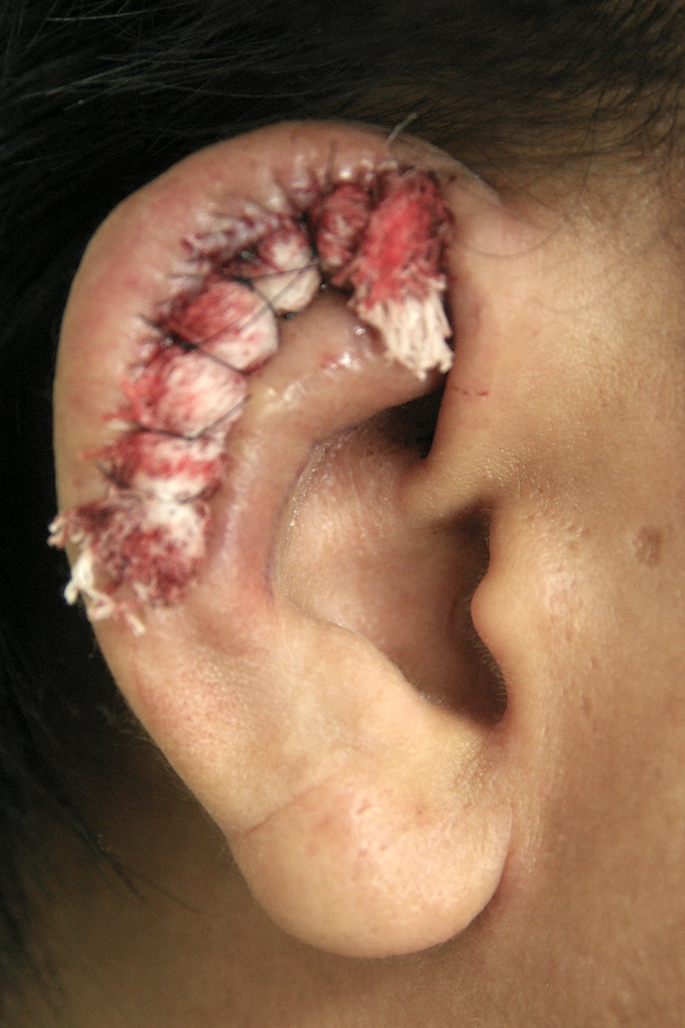 柔道耳術後　大江橋クリニック