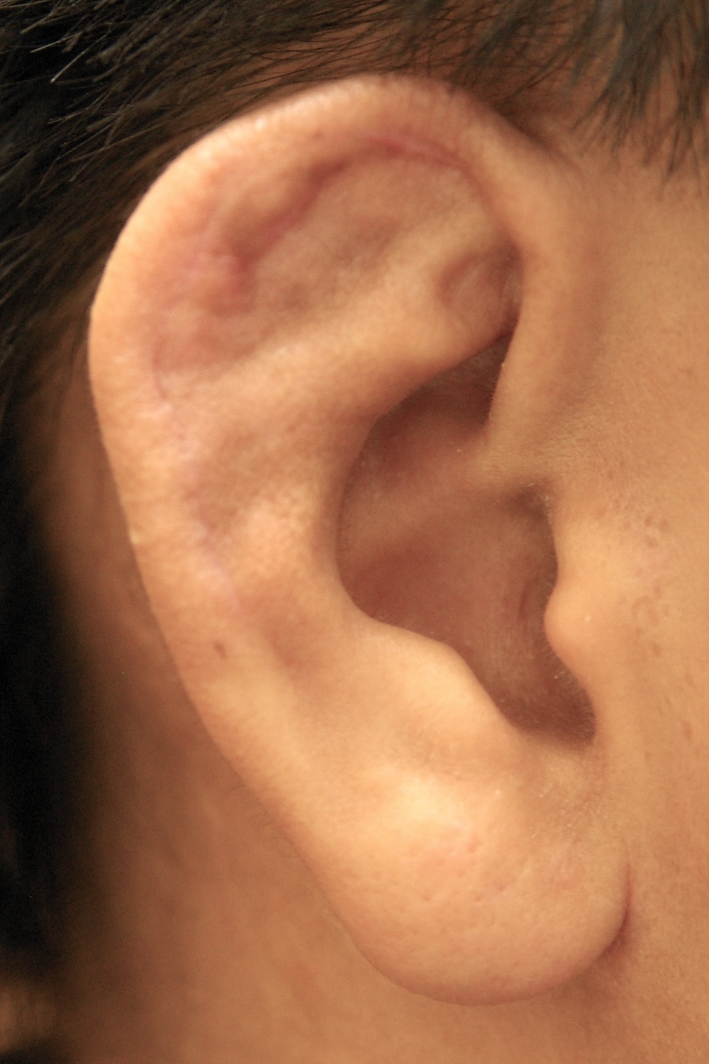 柔道耳術後　大江橋クリニック