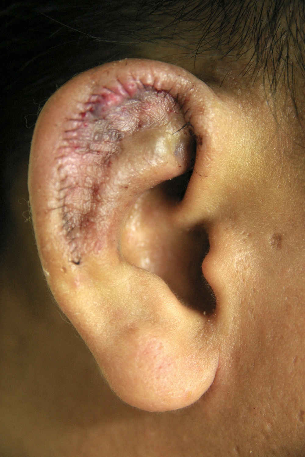 柔道耳術後　大江橋クリニック