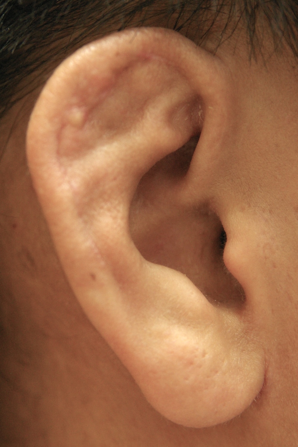 柔道耳術後　大江橋クリニック