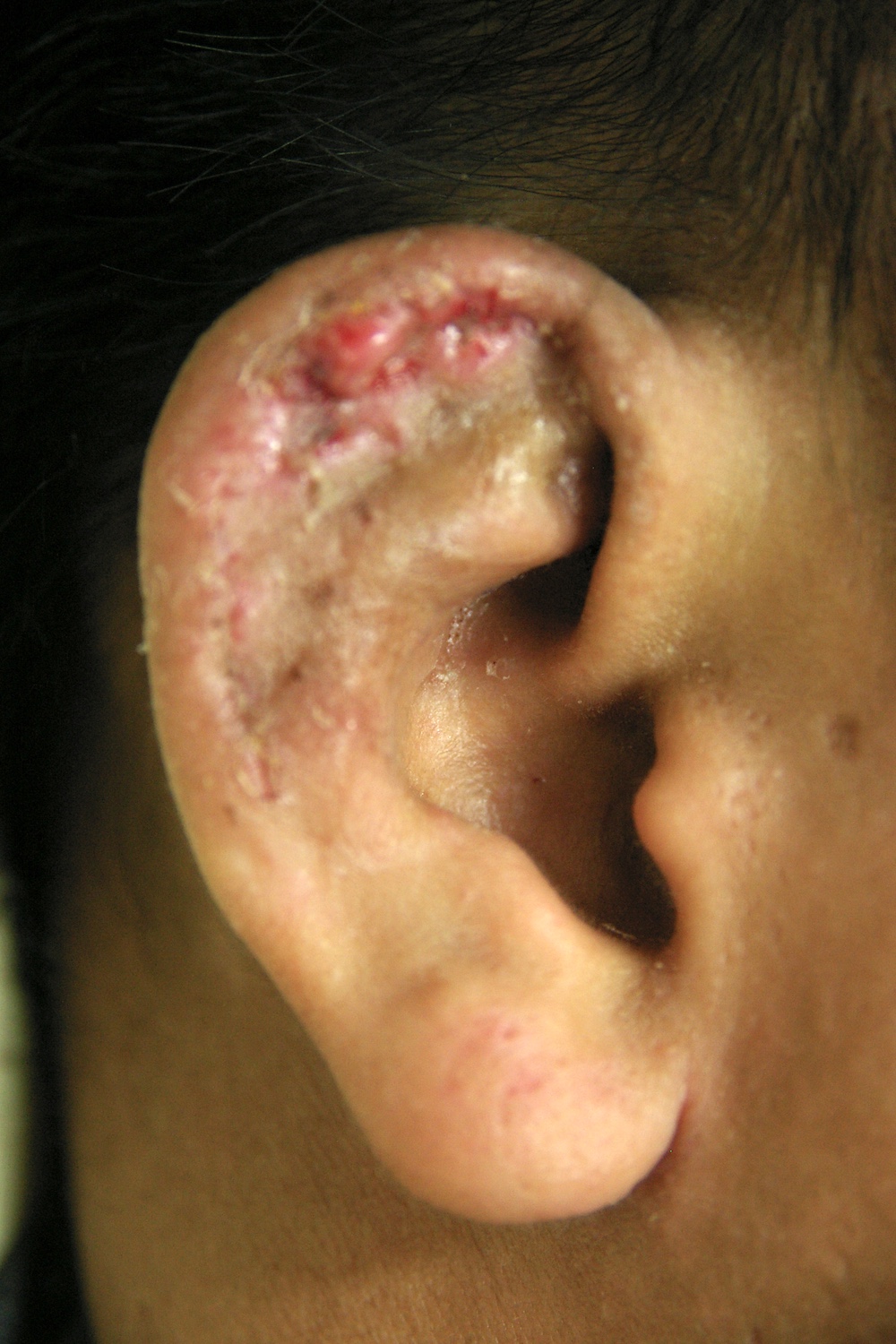 柔道耳術後　大江橋クリニック