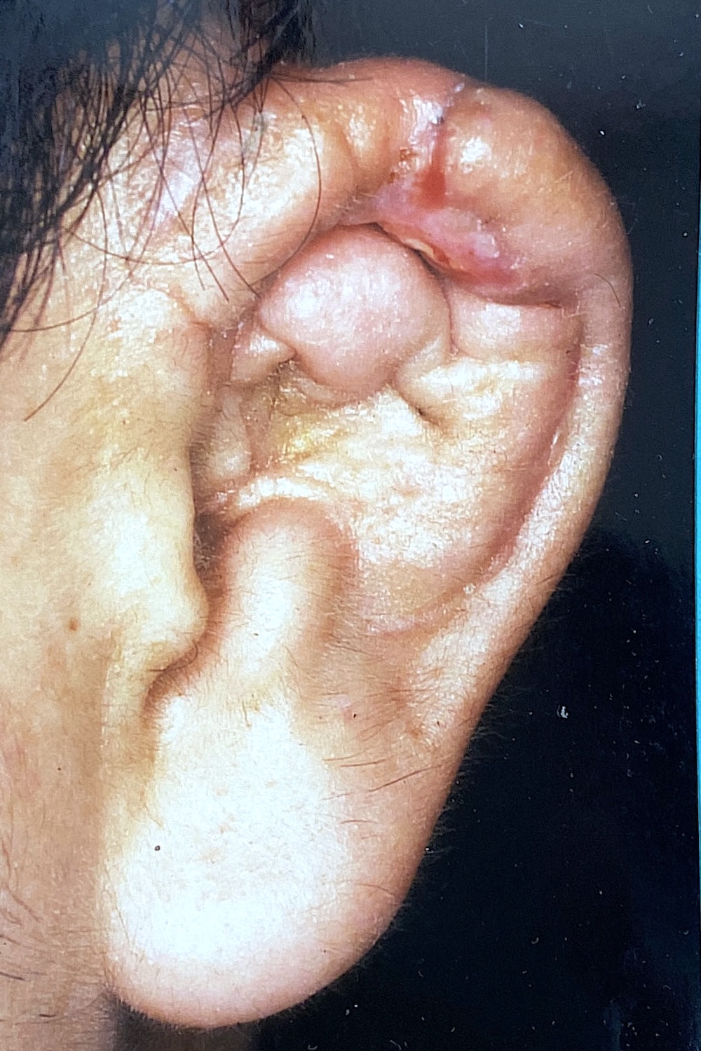 外傷性耳介変形術前　大江橋クリニック