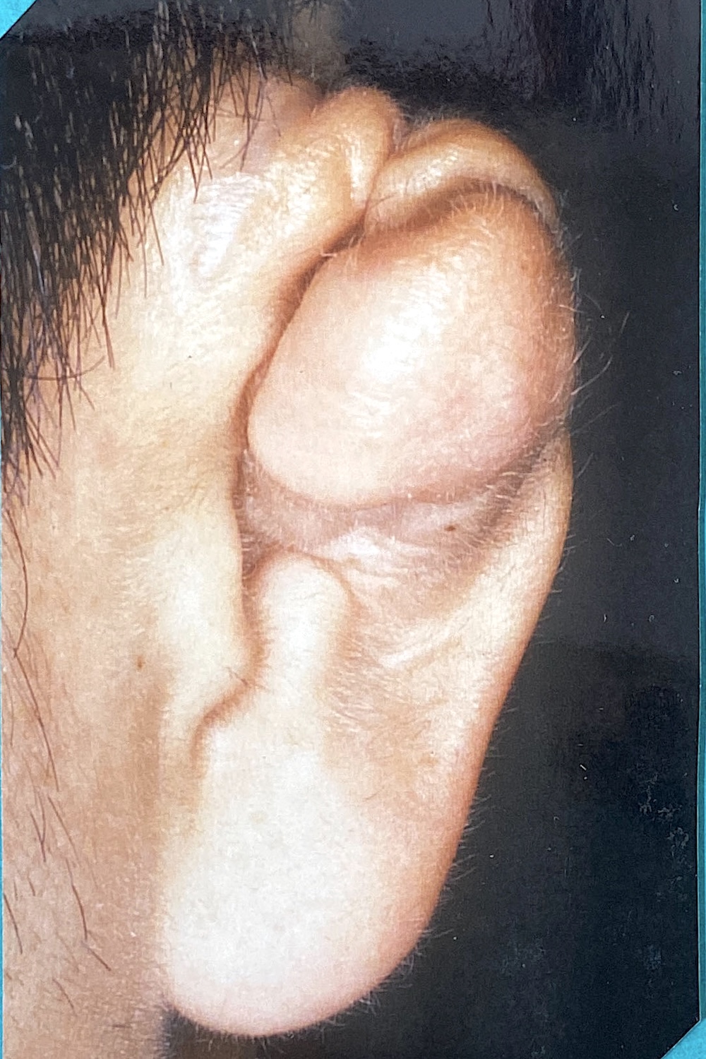 外傷性耳介変形術前　大江橋クリニック